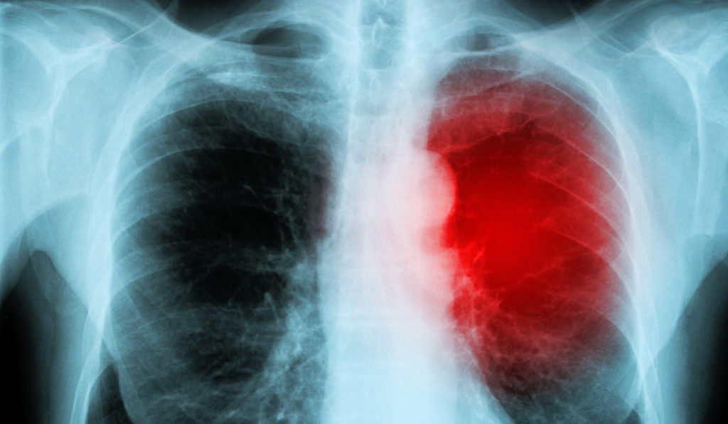 Myocarditis diagram.