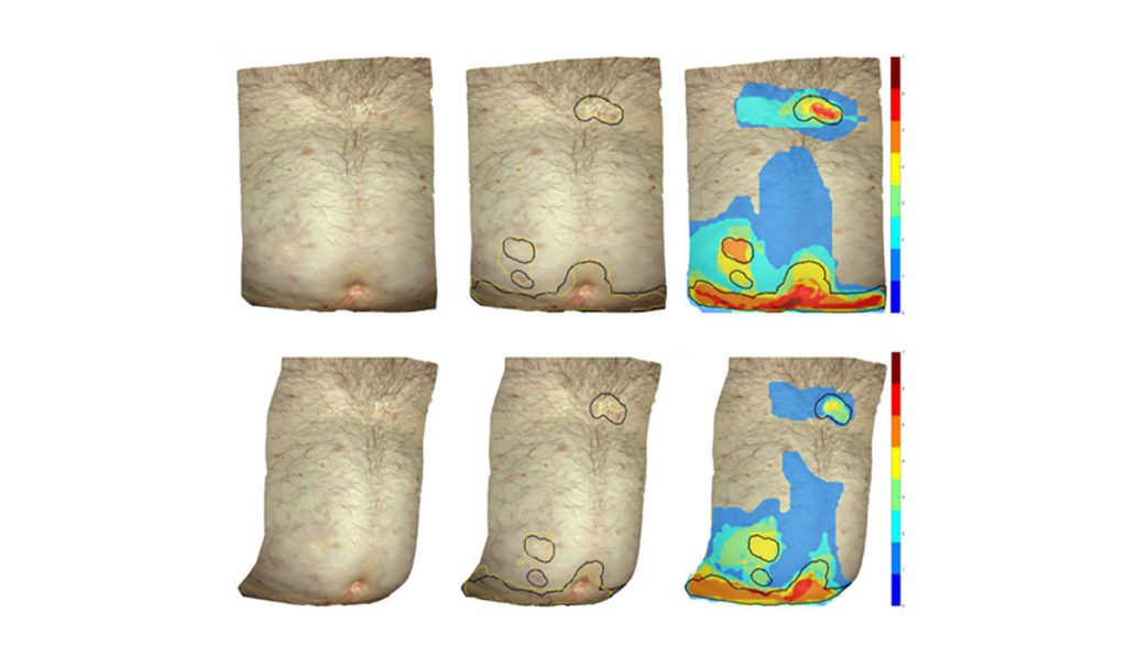 Scans identifying skin lesions caused by GVHD.