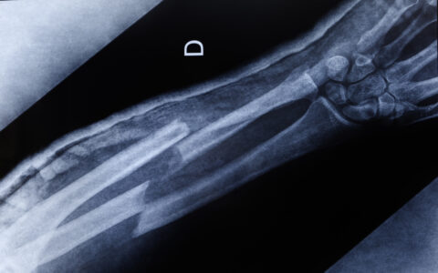 An x-ray of a double fracture in the forearm.