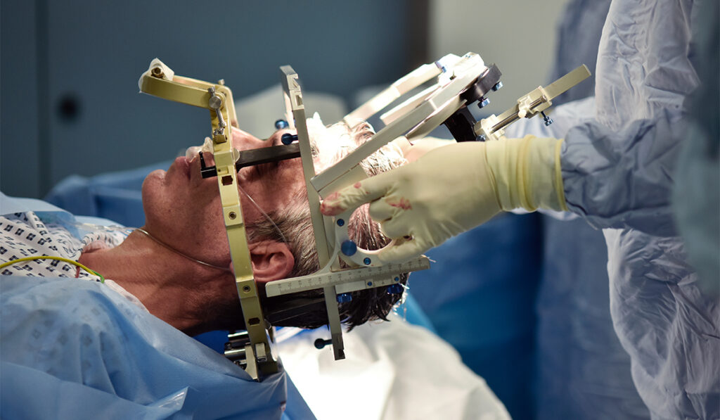 Stereotactic frame being used on a patient's head during deep brain stimulation (DBS) surgery on a 59-year-old man with Parkinson's disease.
