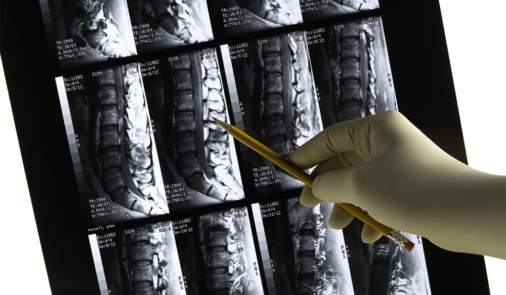 Image of lower back MRI scan