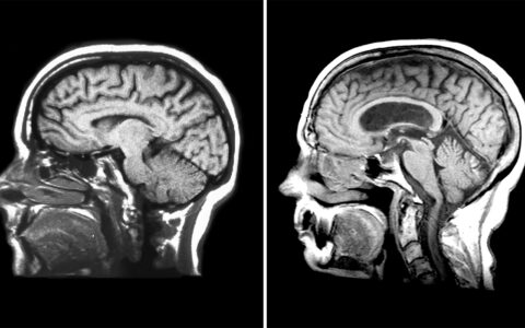 MRI of a normal vs. hydrocephalic brain