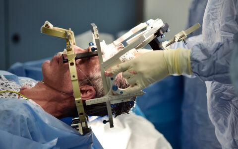 Stereotactic frame being used on a patient's head during deep brain stimulation (DBS) surgery on a 59-year-old man with Parkinson's disease.